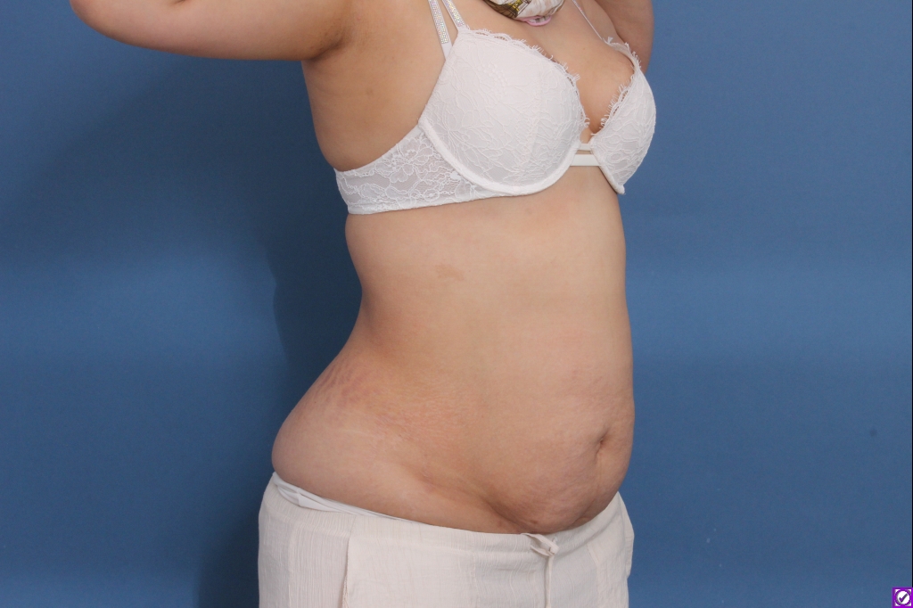 Before tummy tuck with liposuction in Nashville, TN, case 001, left oblique